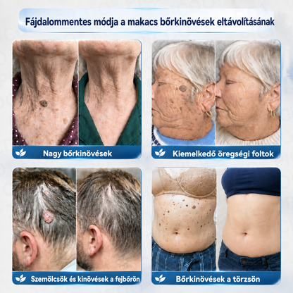 Picdo® 7‑denní krém k odstraňování kožních výrůstků a pigmentových skvrn 🧴(𝐒𝐜𝐡𝐦𝐞𝐫𝐳𝐟𝐫𝐞𝐢𝐞 𝐅𝐨𝐫𝐦𝐞𝐥 – 𝐨𝐡𝐧𝐞 𝐍𝐚𝐫𝐛𝐞𝐧) 🛡️
