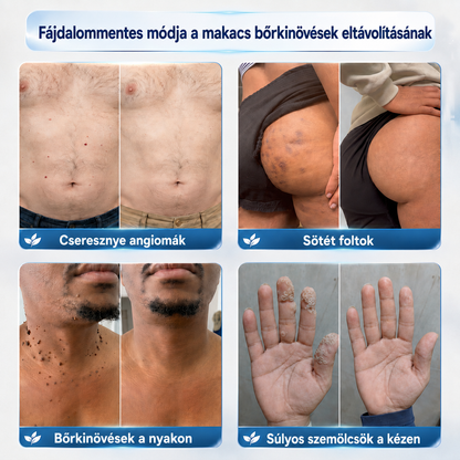 Picdo® 7‑denní krém k odstraňování kožních výrůstků a pigmentových skvrn 🧴(𝐒𝐜𝐡𝐦𝐞𝐫𝐳𝐟𝐫𝐞𝐢𝐞 𝐅𝐨𝐫𝐦𝐞𝐥 – 𝐨𝐡𝐧𝐞 𝐍𝐚𝐫𝐛𝐞𝐧) 🛡️